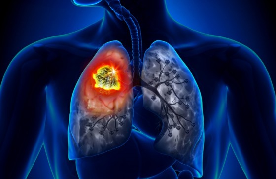 aport-vitamina-b-cancer-pulmonar